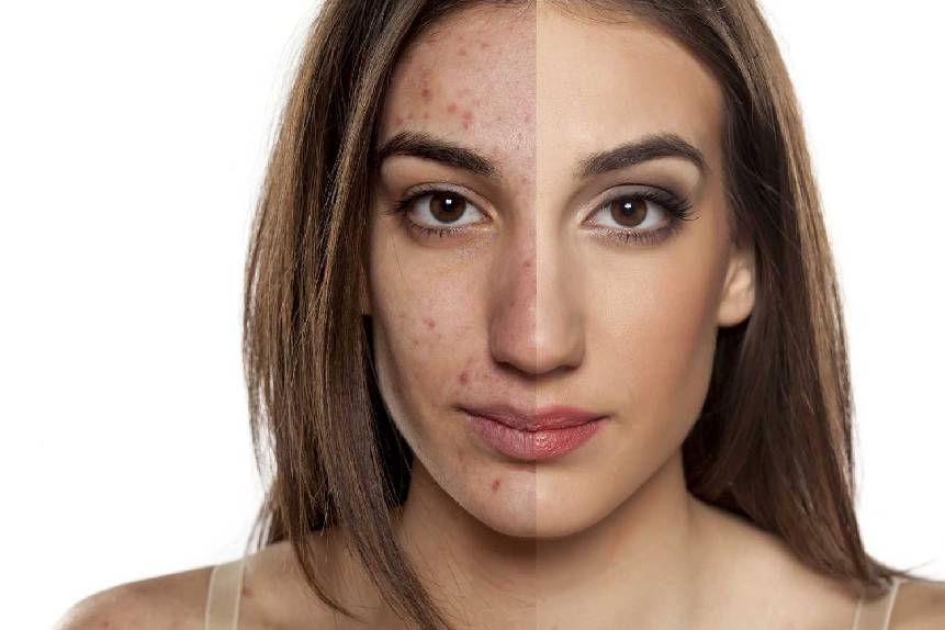 Acne Treatment In Delhi From Skin Expert