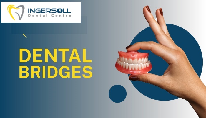 Dental Bridges Services
