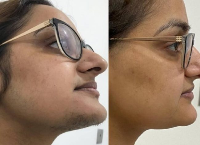 laser hair clinic london