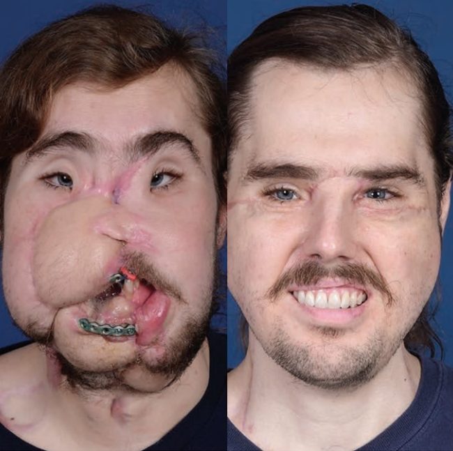 Facial Reconstruction Surgery in Dubai
