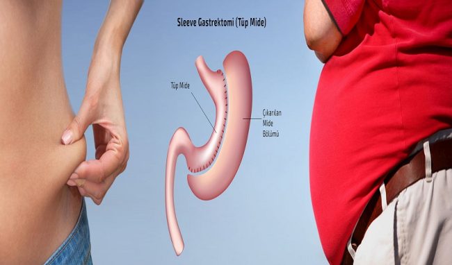 Gastric sleeve