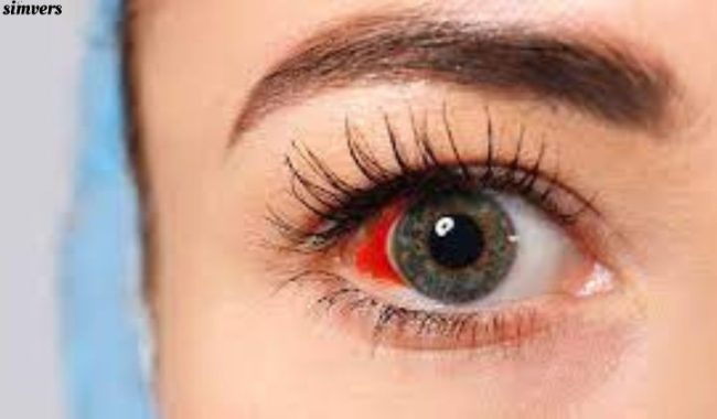 Spiritual Meaning of Broken Blood Vessel in Eye